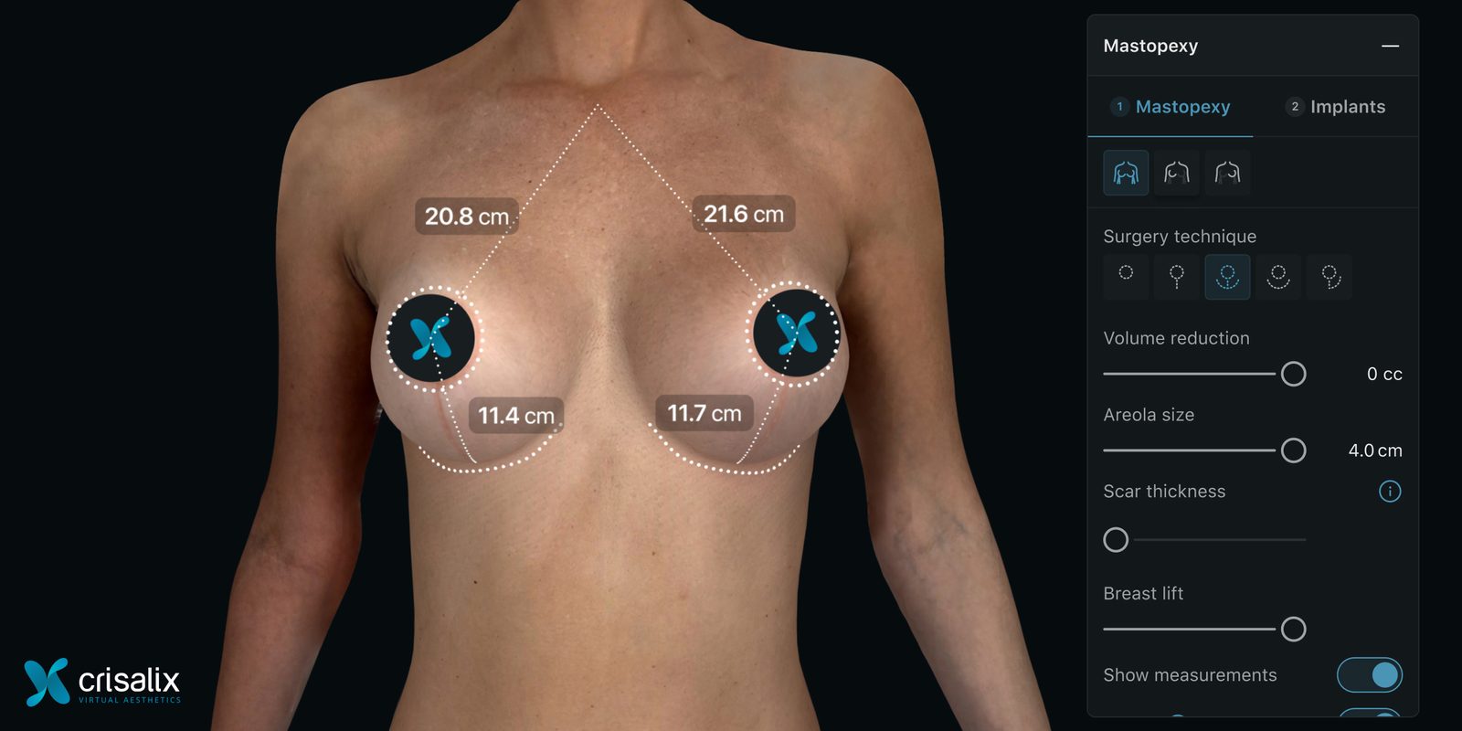 Crisalix 3D breast augmentation simulation showing implant sizing and breast measurements at Kiwanuka Plastic Surgery in New York City