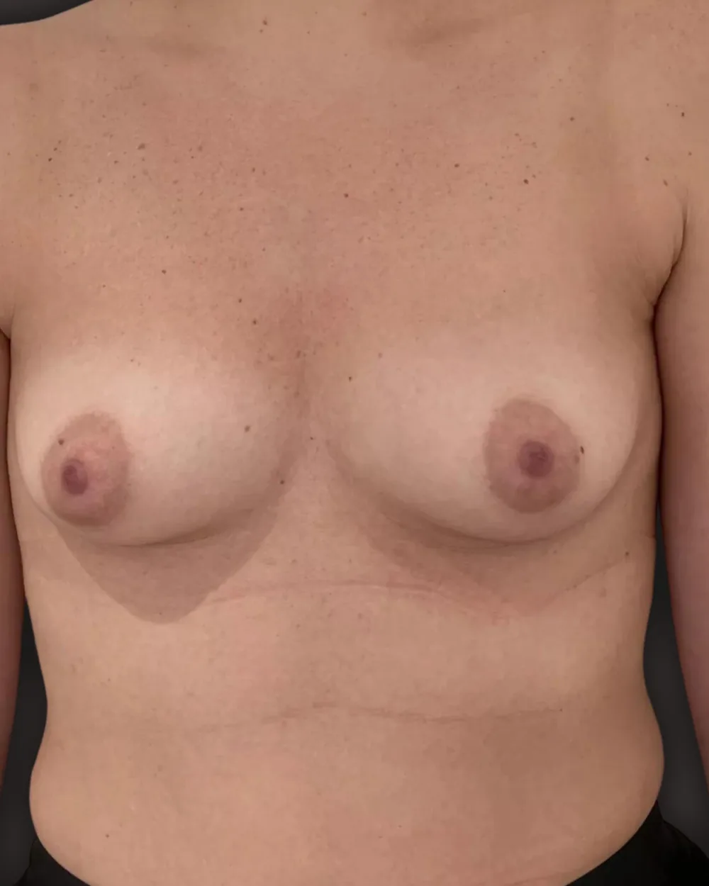 Breast augmentation, before, anterior view