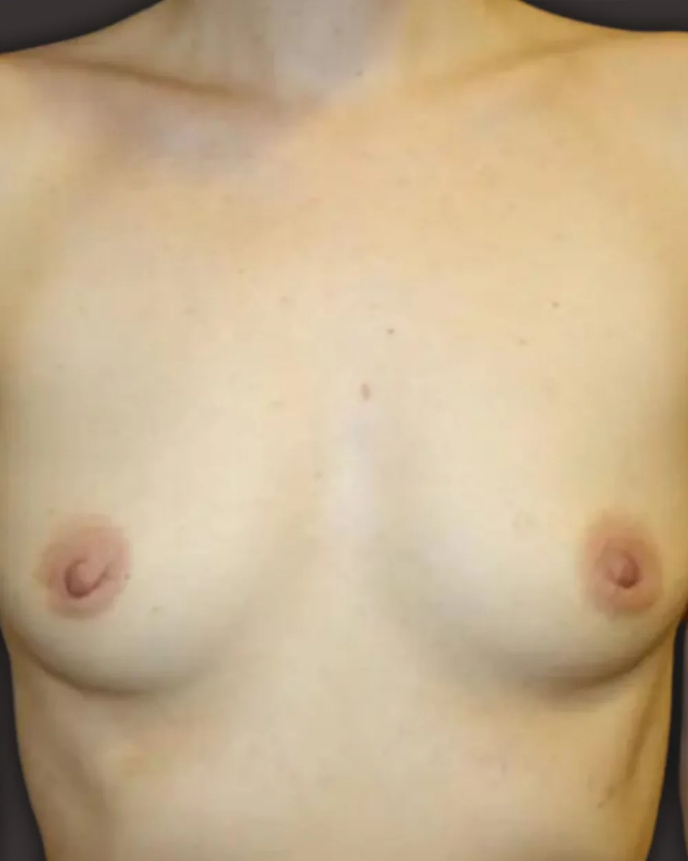 Breast augmentation, before, anterior view
