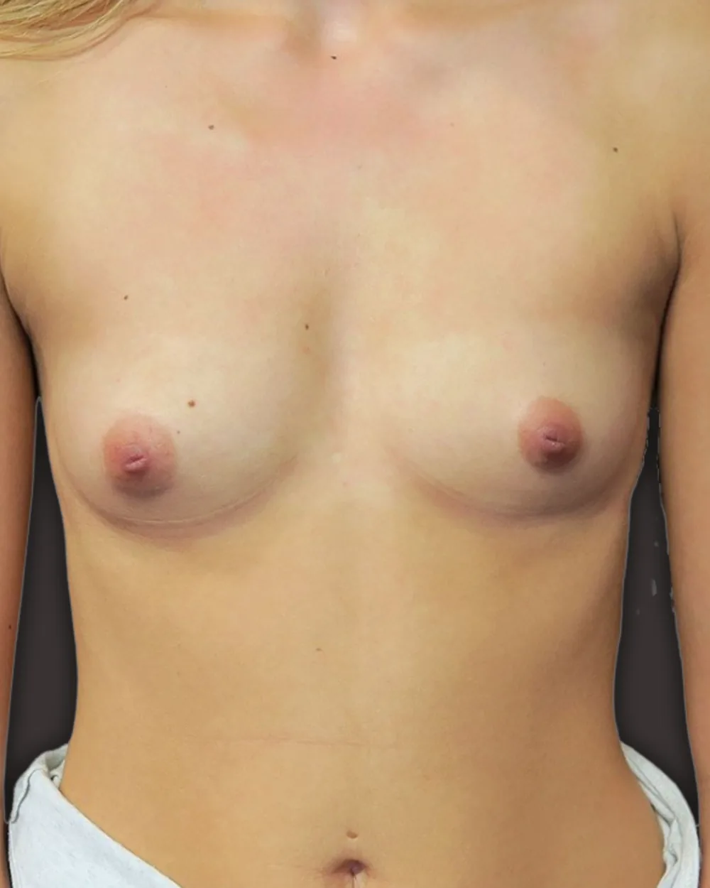 Breast augmentation, before, anterior view