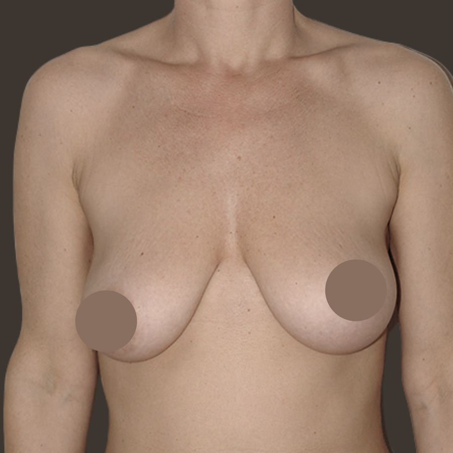 Breast lift, before, front view