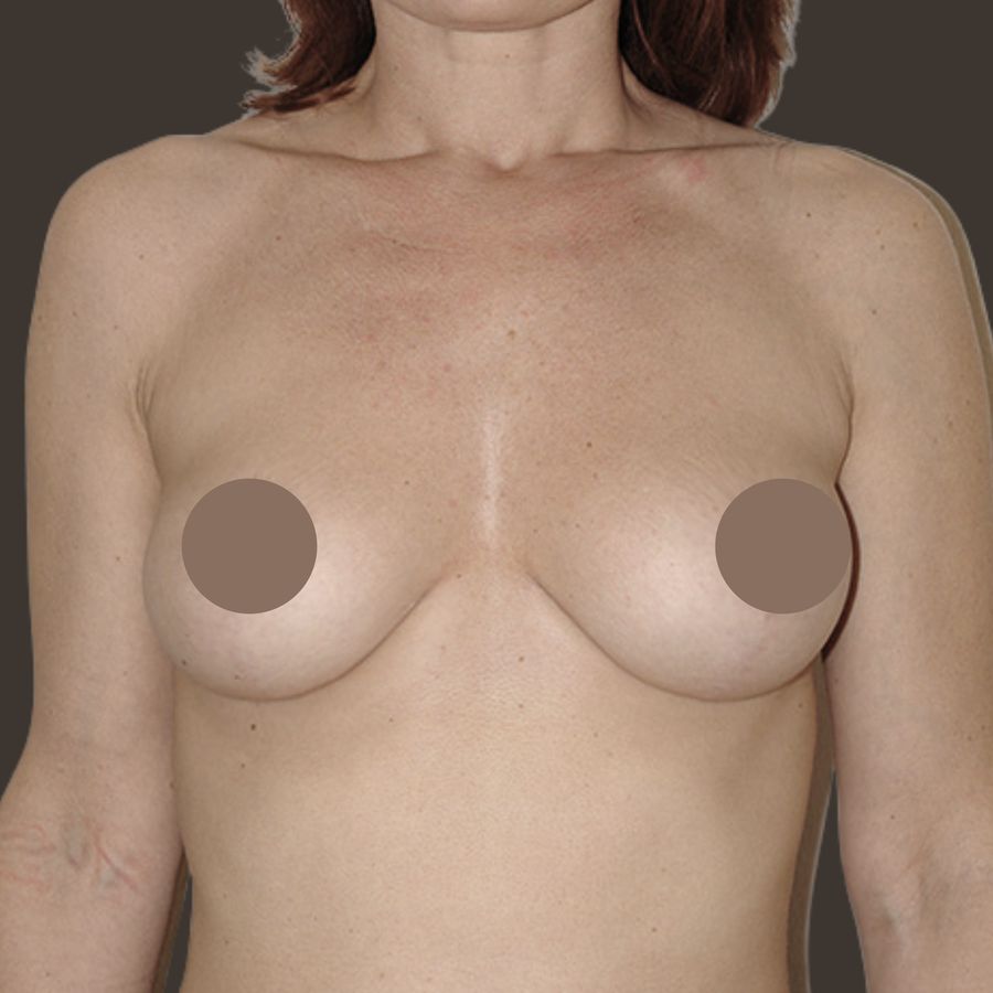 Breast lift, after, front view