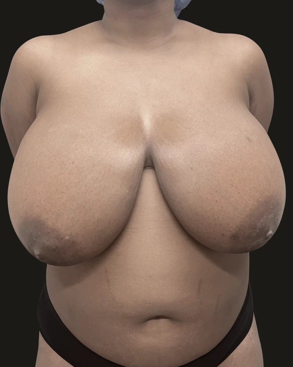 Breast reduction, before, anterior view