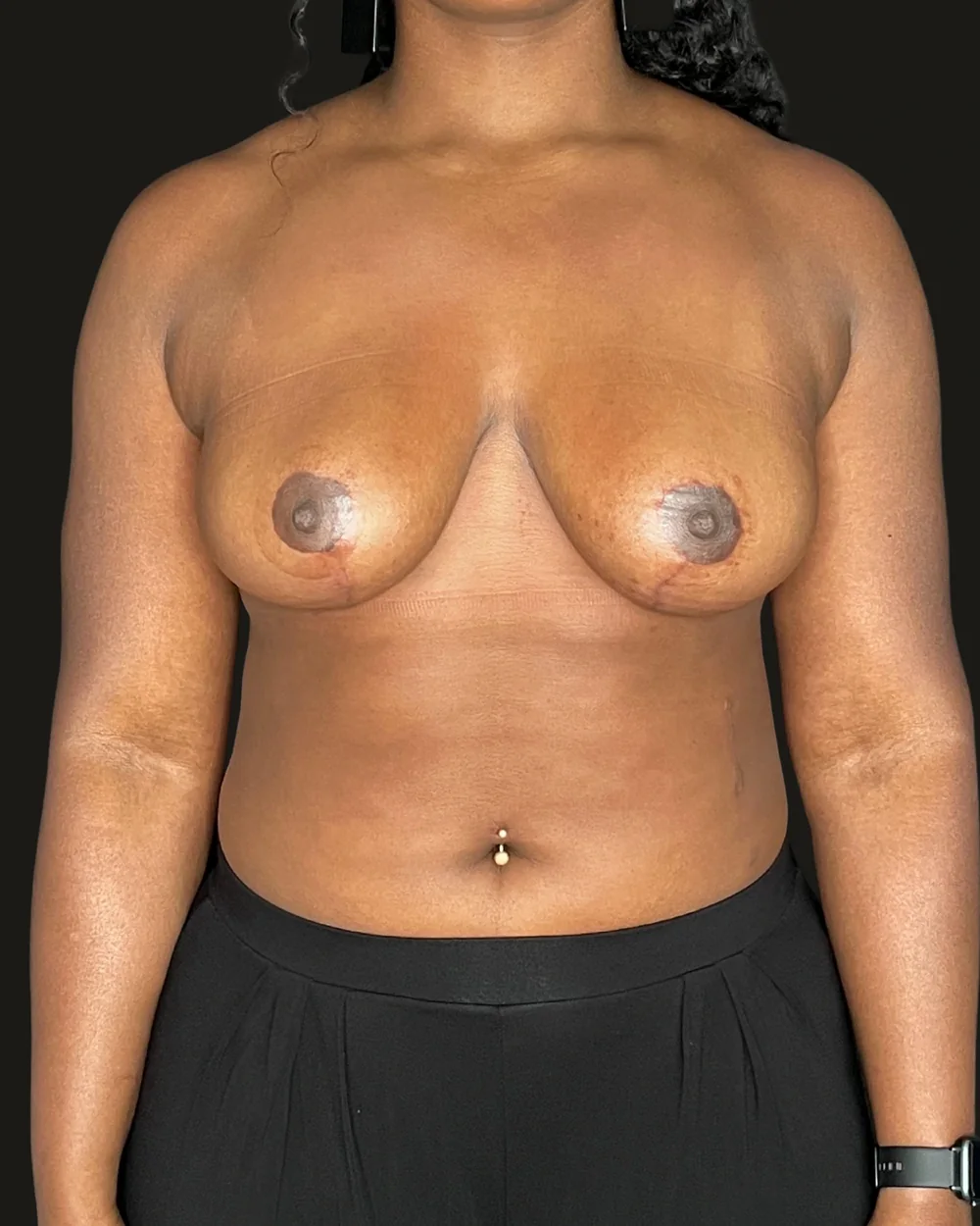 Breast reduction, after, anterior view
