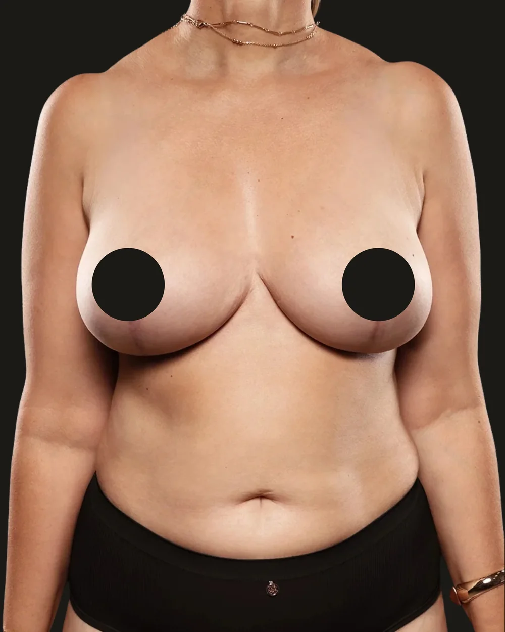 Breast reduction, after, anterior view