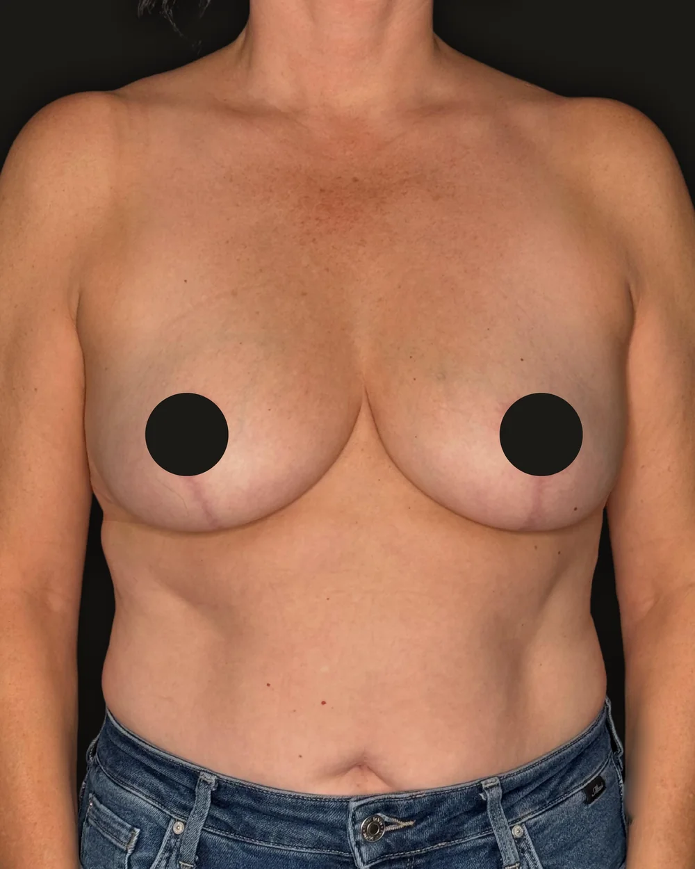 Breast reduction, after, anterior view