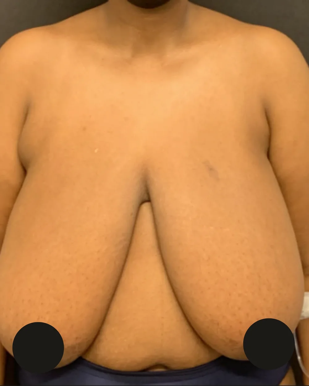 Breast reduction, before, anterior view