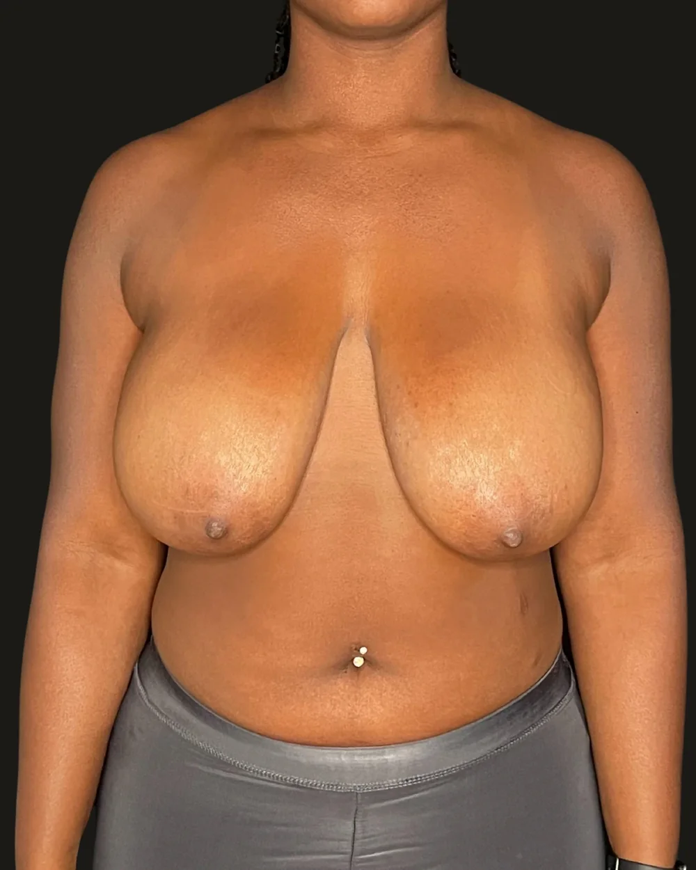 Breast reduction, before, anterior view