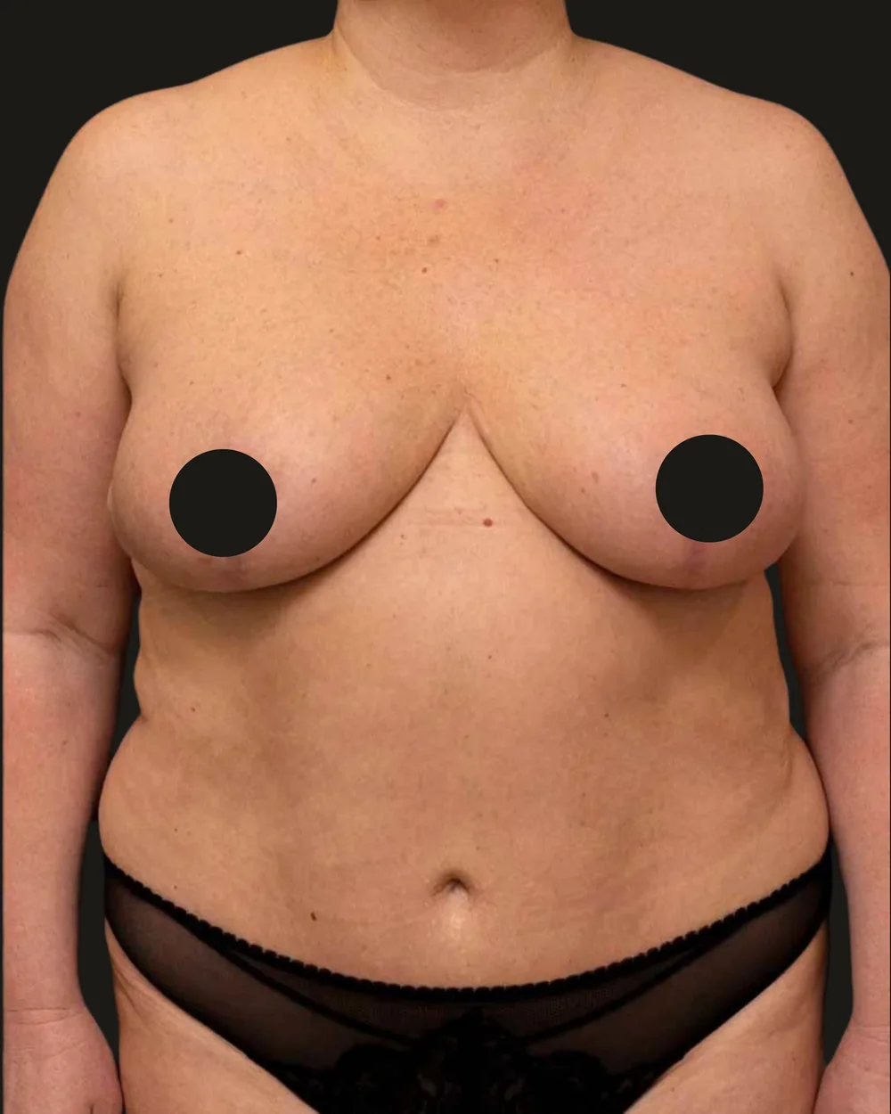 Breast reduction, after, anterior view