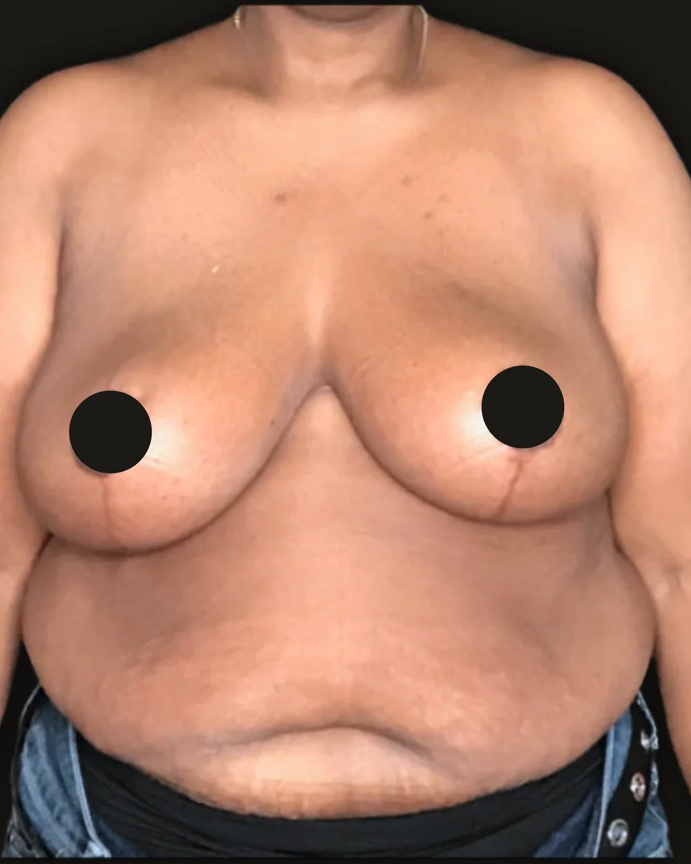 Breast reduction, after, anterior view