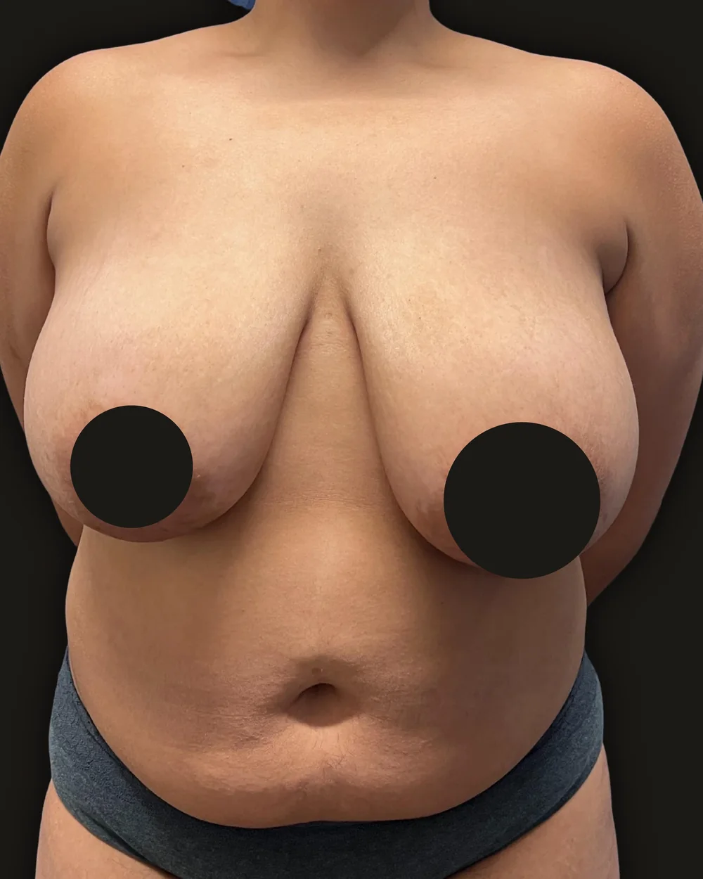 Breast reduction, before, anterior view