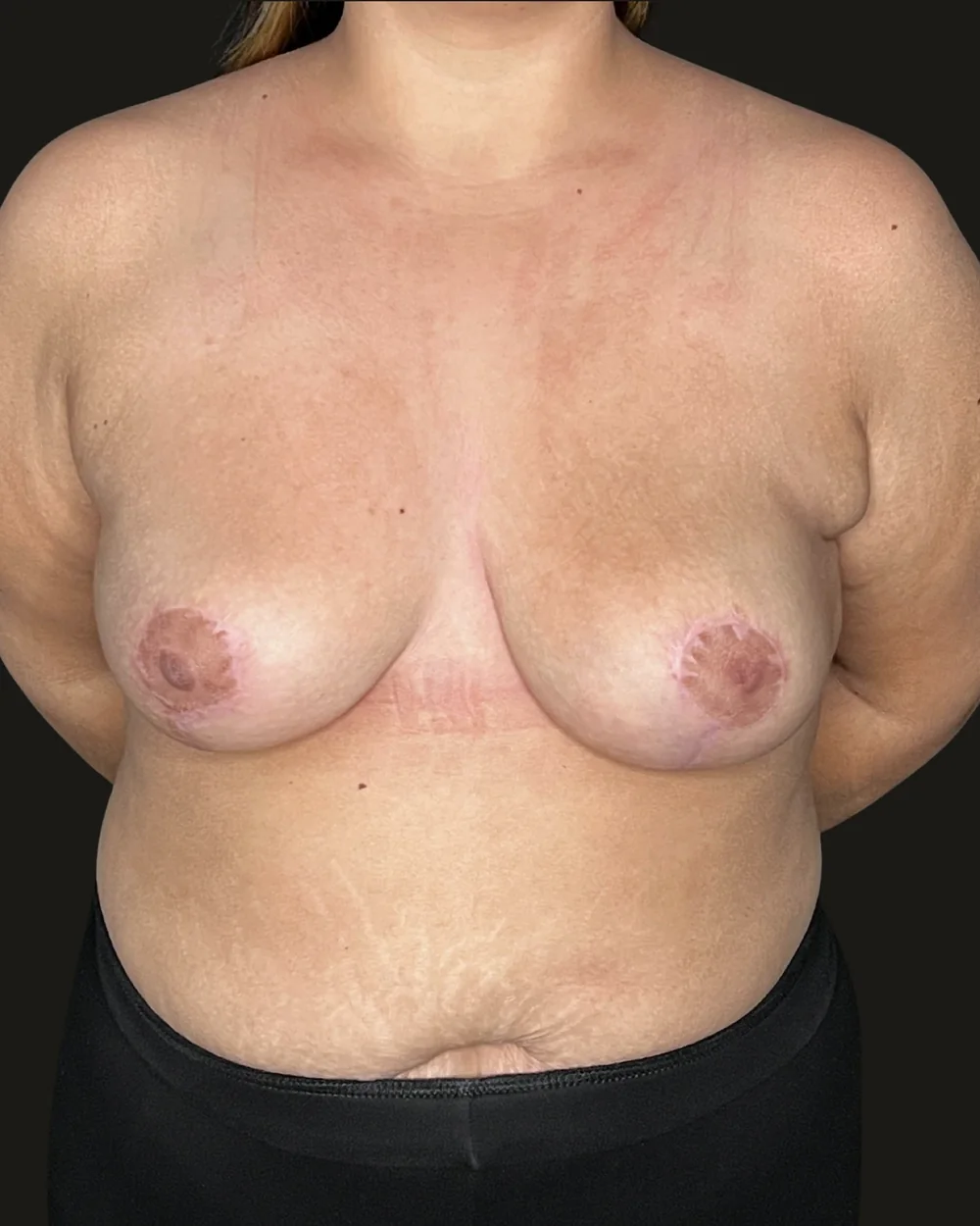 Breast reduction, after, anterior view
