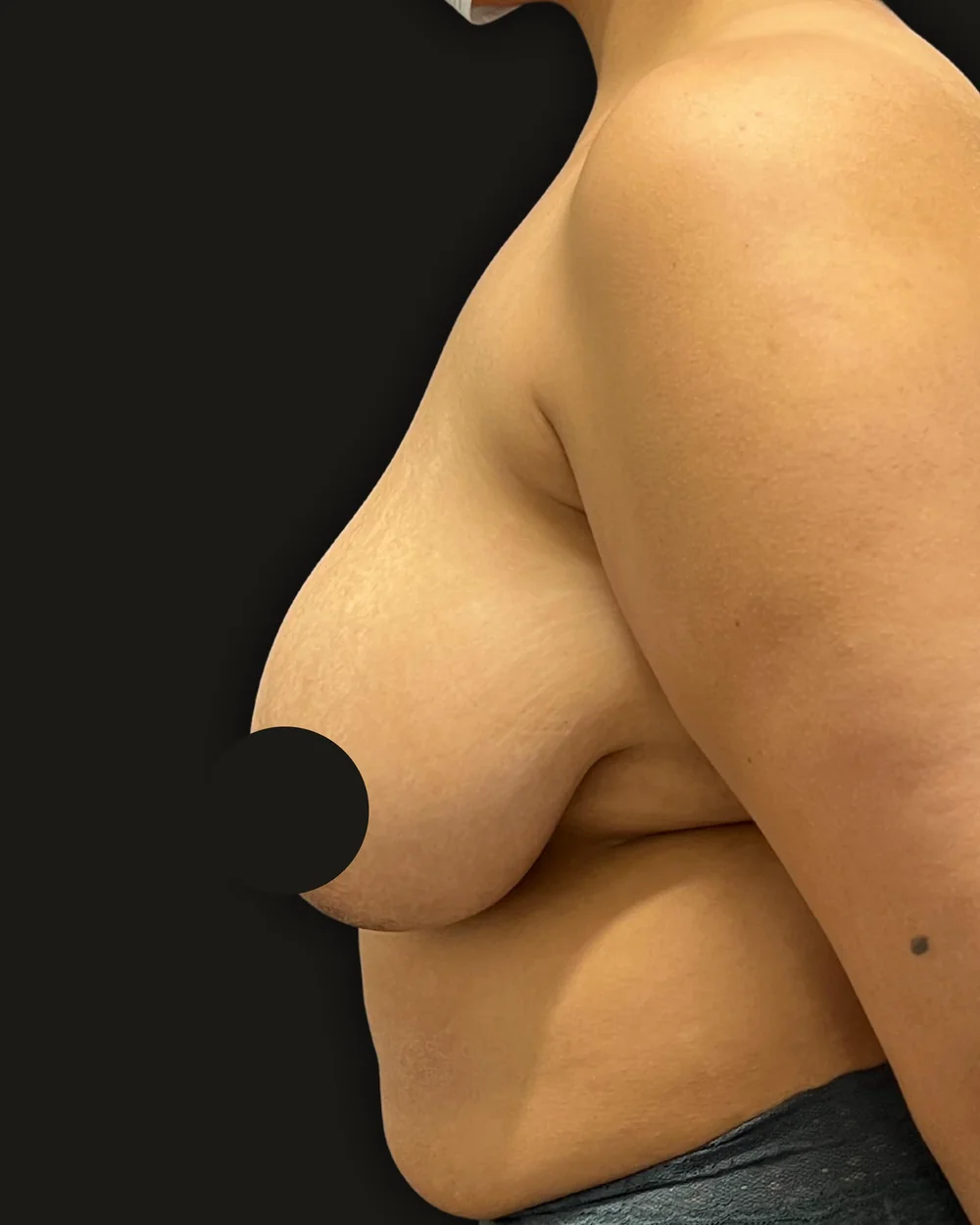Breast reduction, before, anterior view