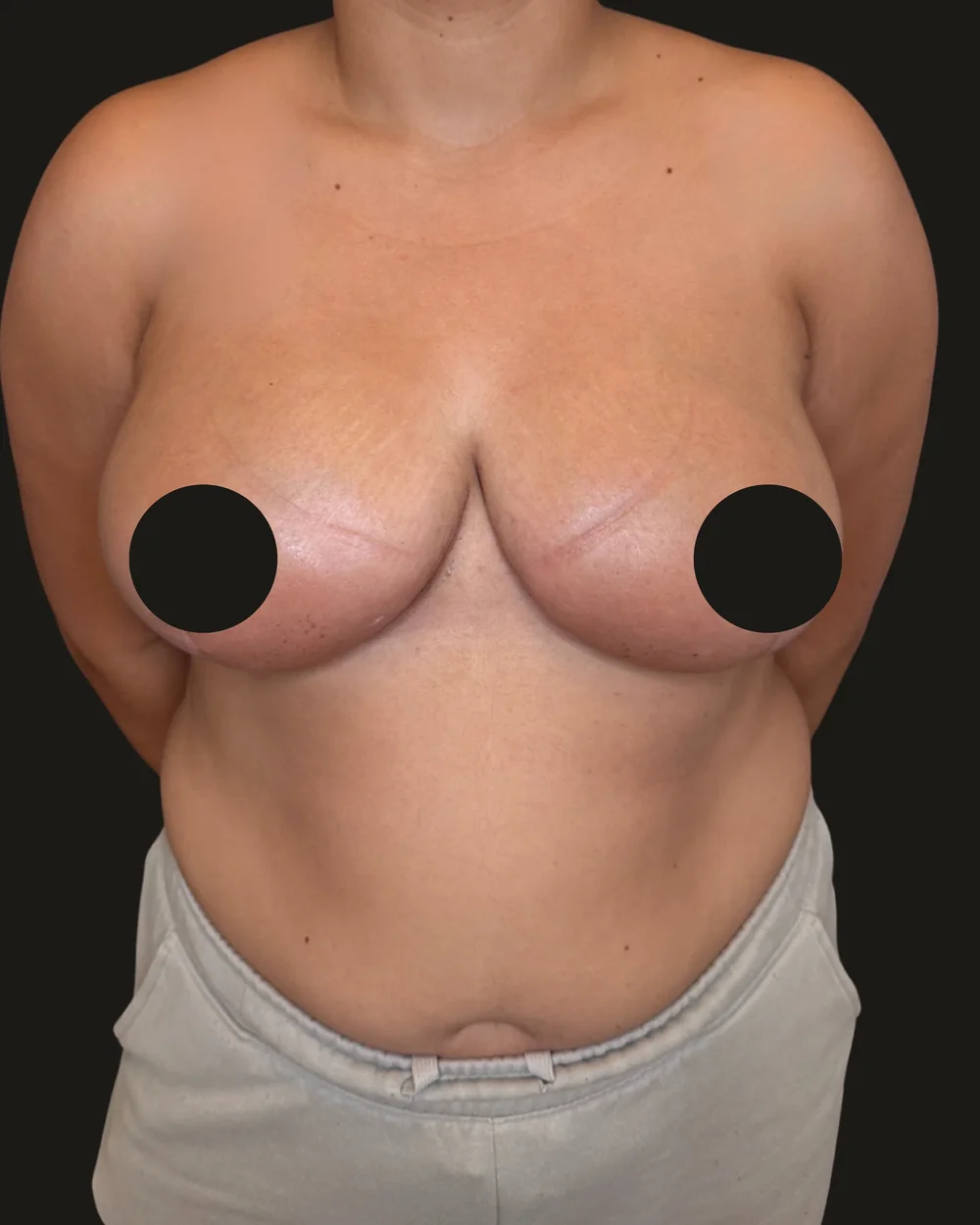 Breast reduction, after, anterior view