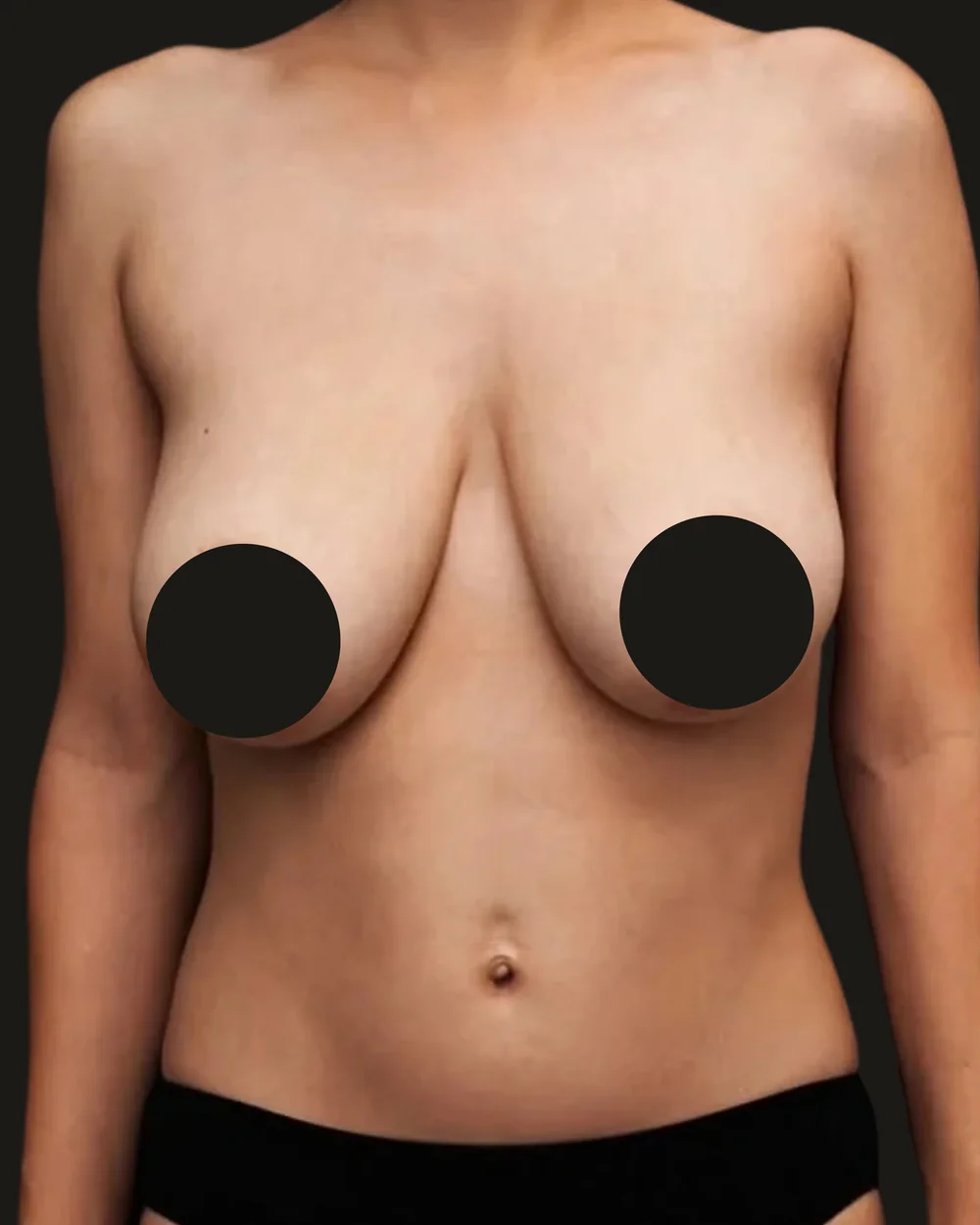 Breast reduction, before, anterior view