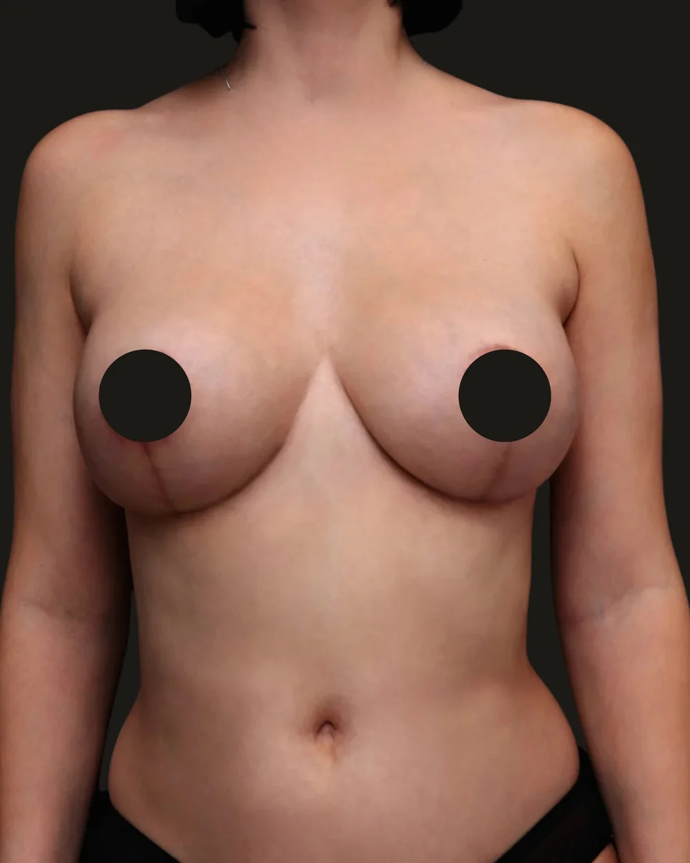 Breast reduction, after, anterior view