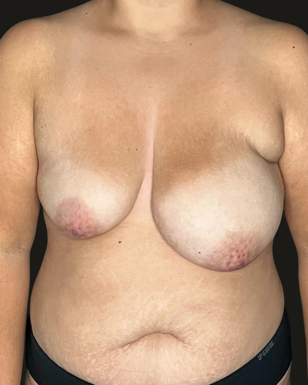 Breast reduction, before, anterior view