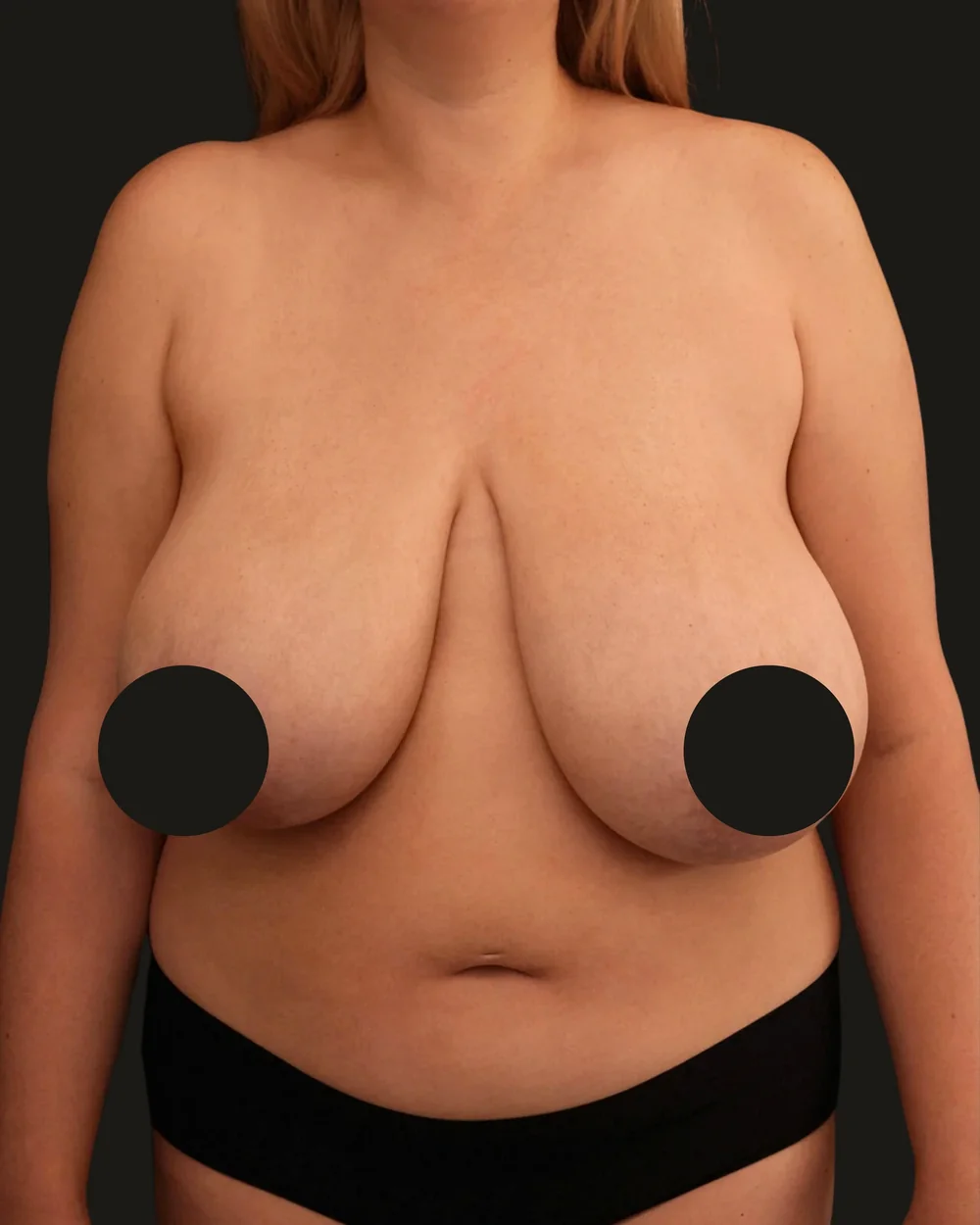 Breast reduction, before, anterior view