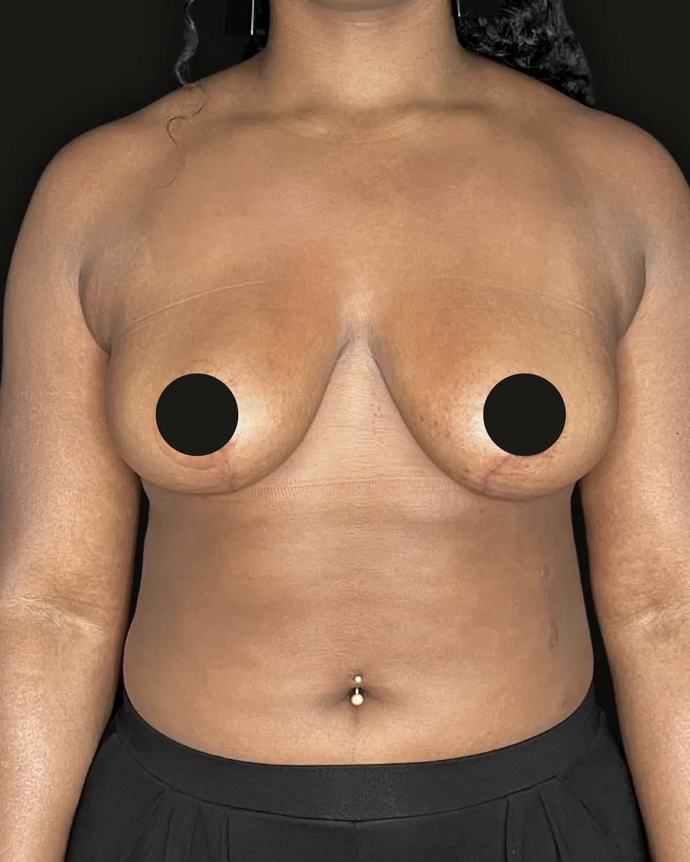 Breast reduction, after, anterior view