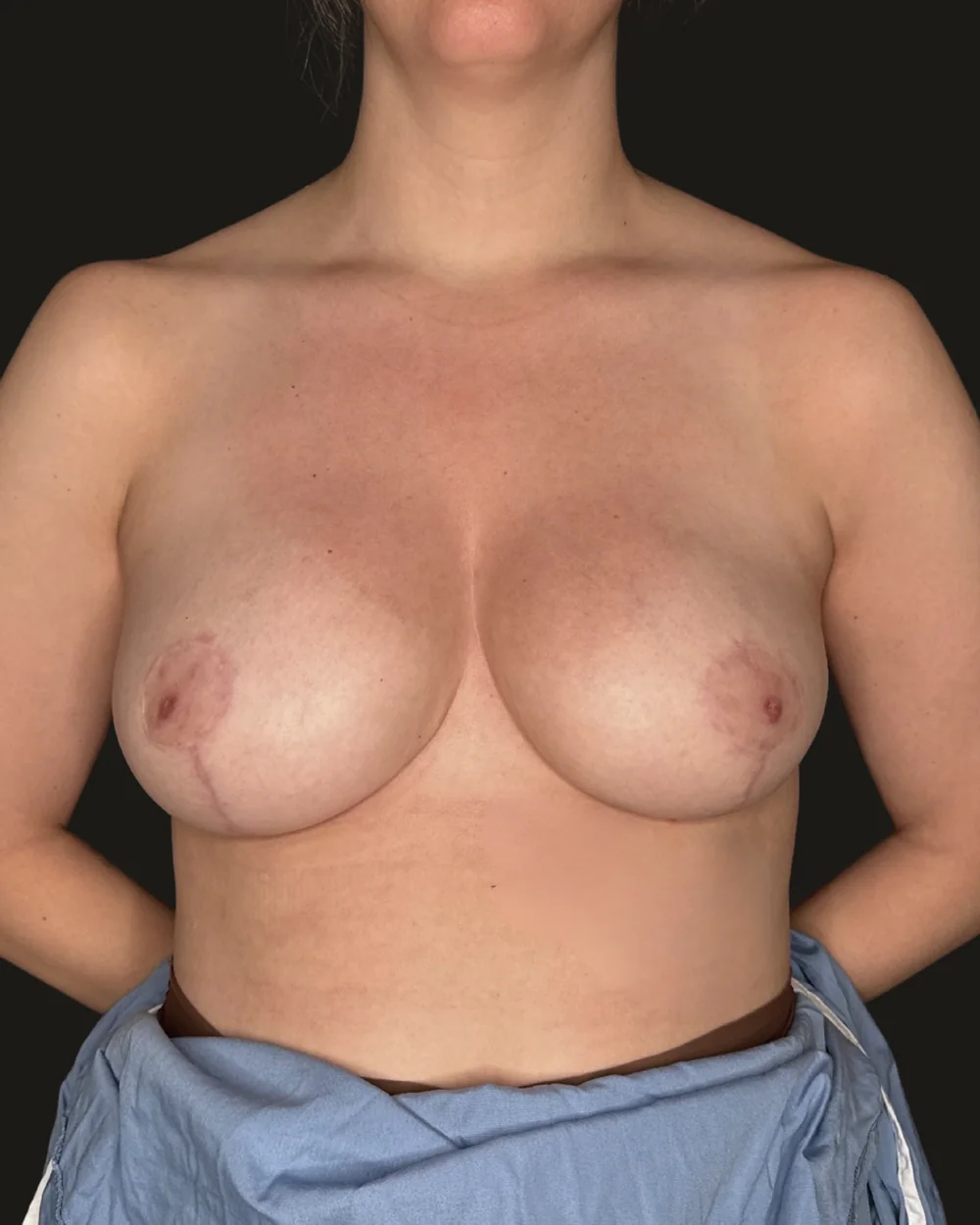 Breast reduction, after, anterior view