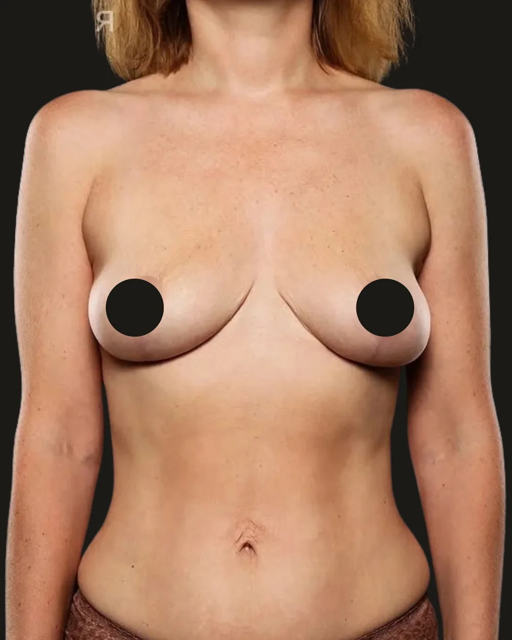 Breast reduction, after, anterior view