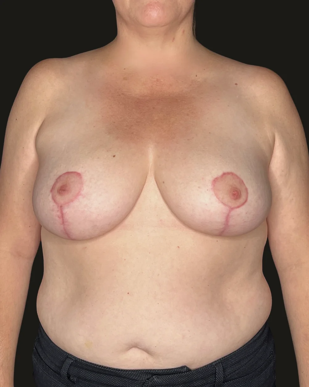 Breast reduction, after, anterior view