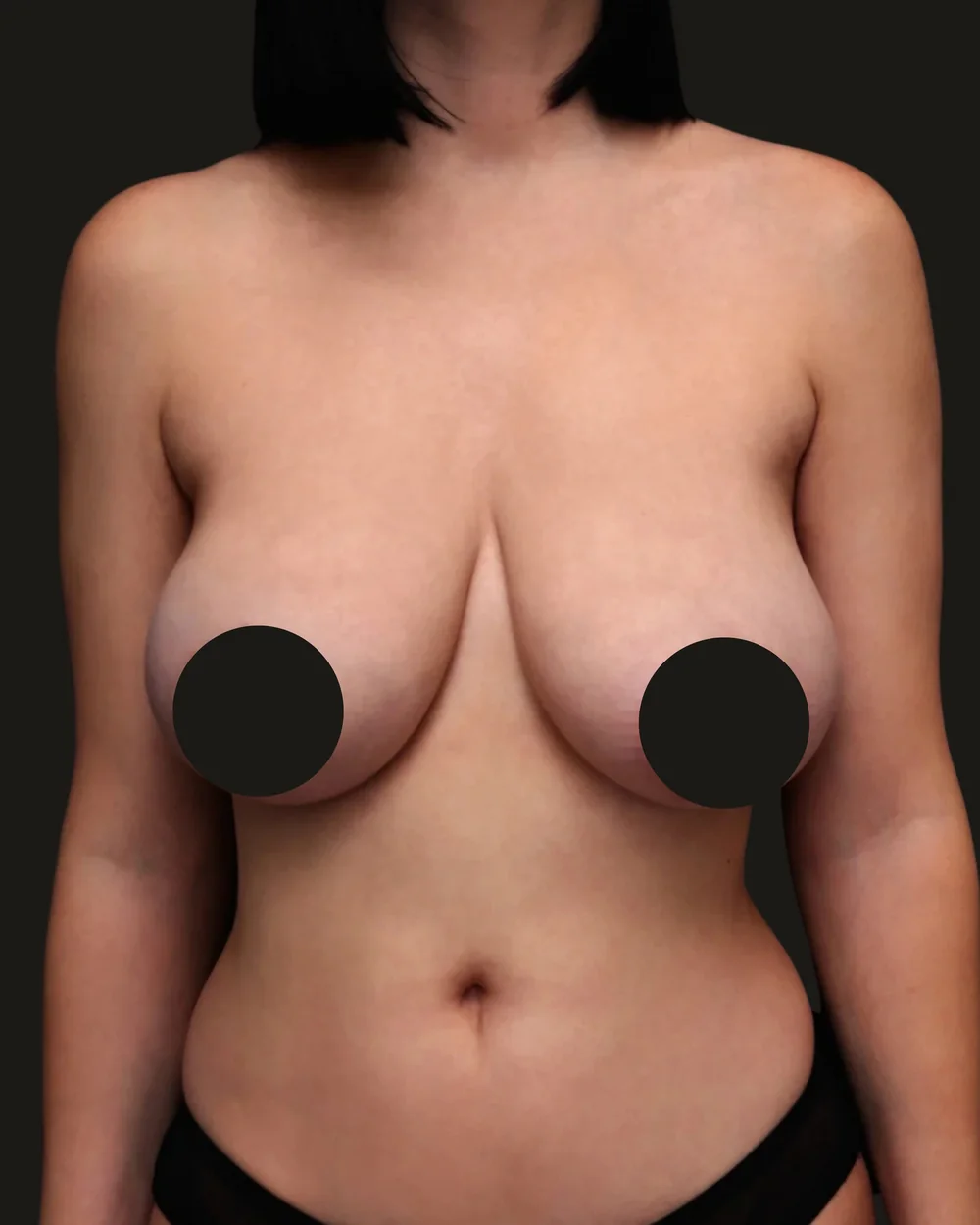 Breast reduction, before, anterior view