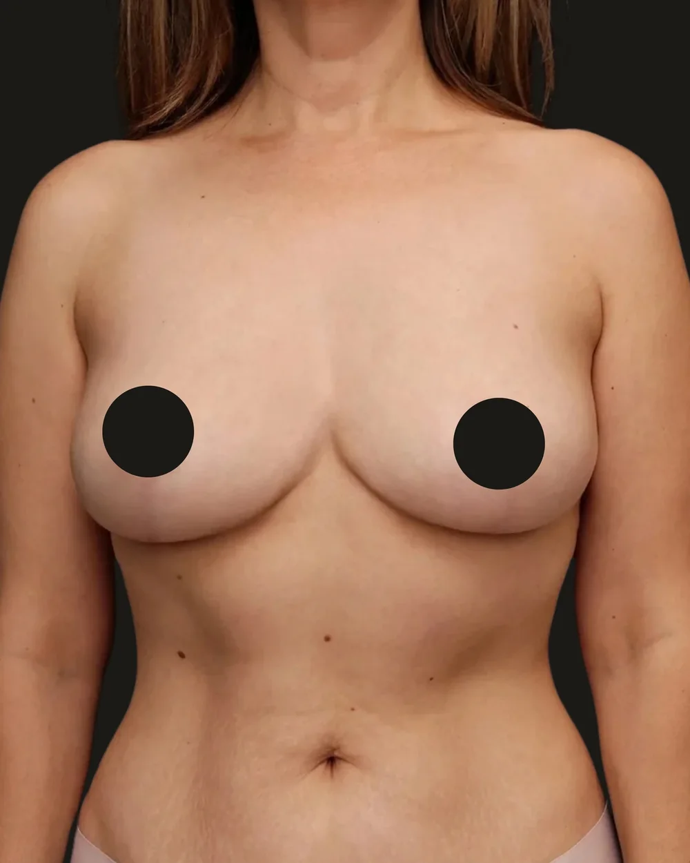 Breast reduction, after, anterior view