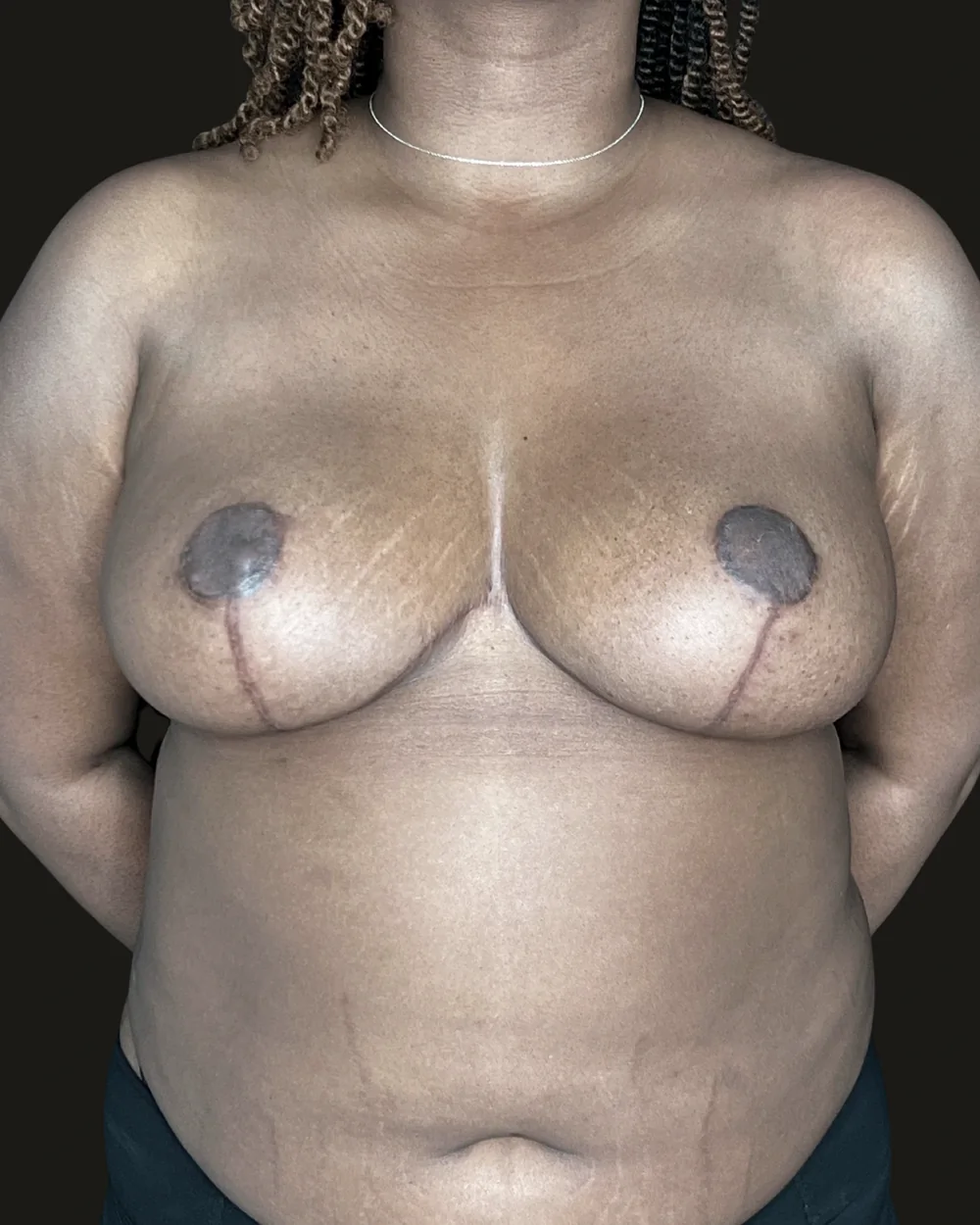 Breast reduction, after, anterior view