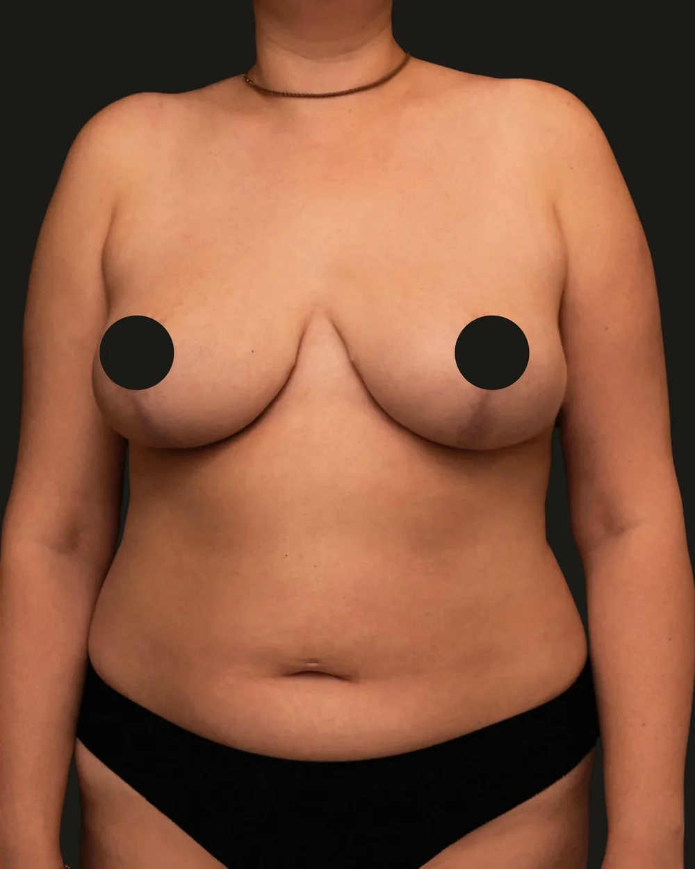 Breast reduction, after, anterior view