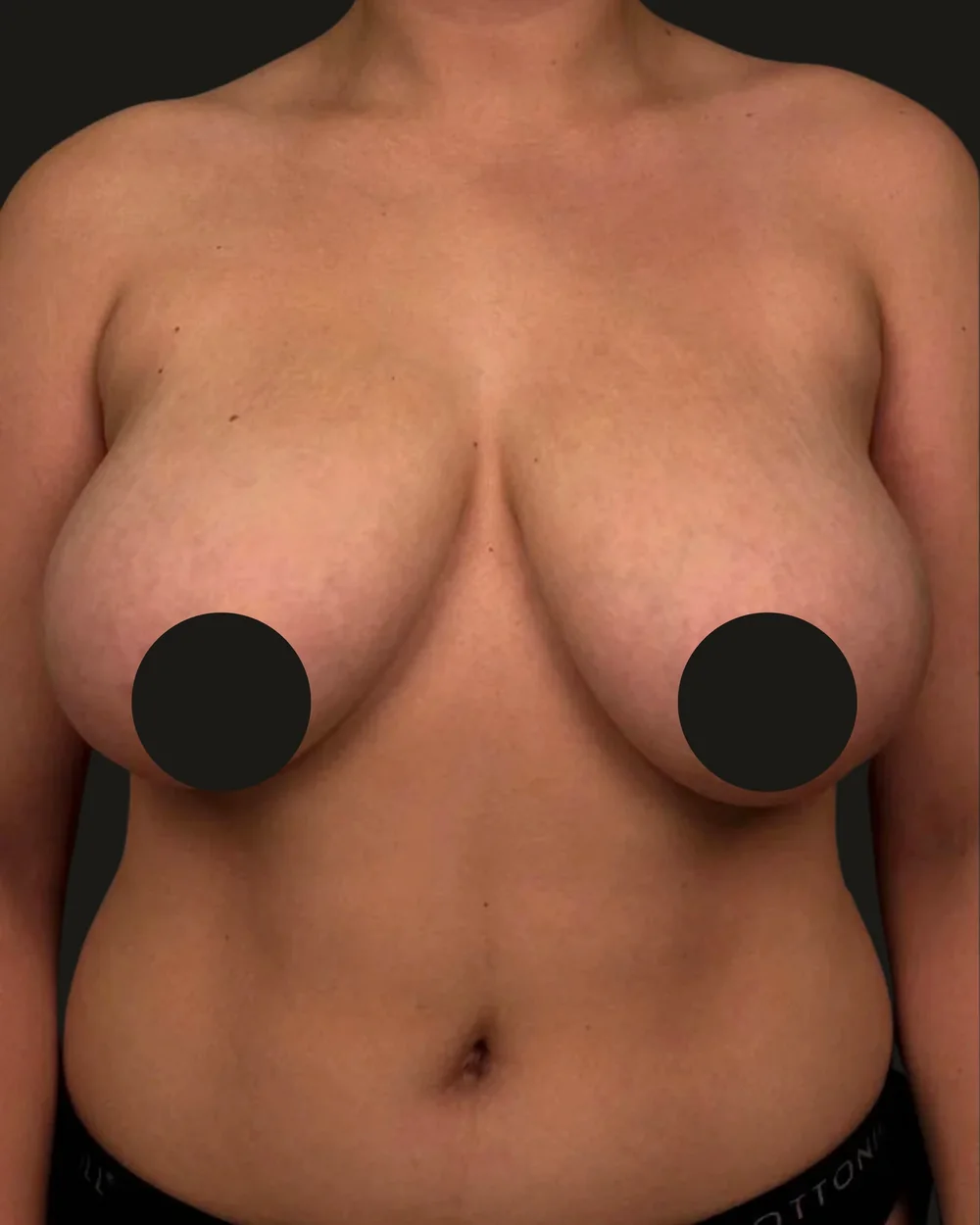 Breast reduction, before, anterior view