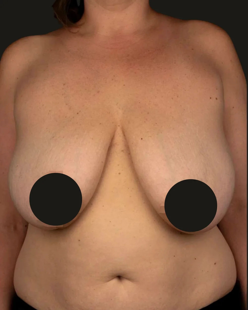 Breast reduction, before, anterior view