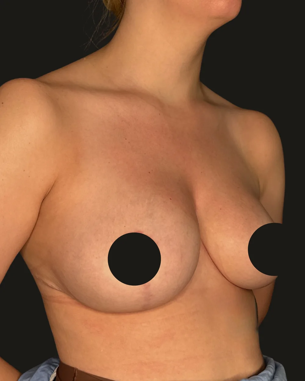 Breast reduction, after, anterior view
