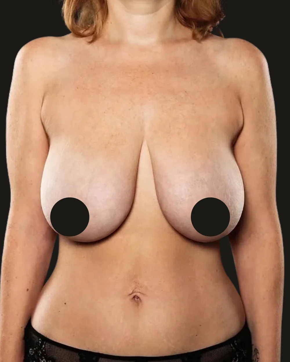 Breast reduction, before, anterior view