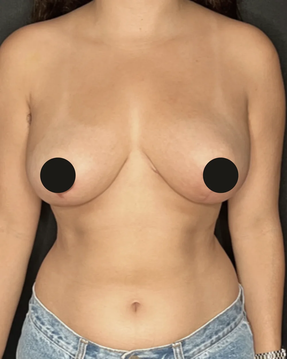 Breast reduction, after, anterior view