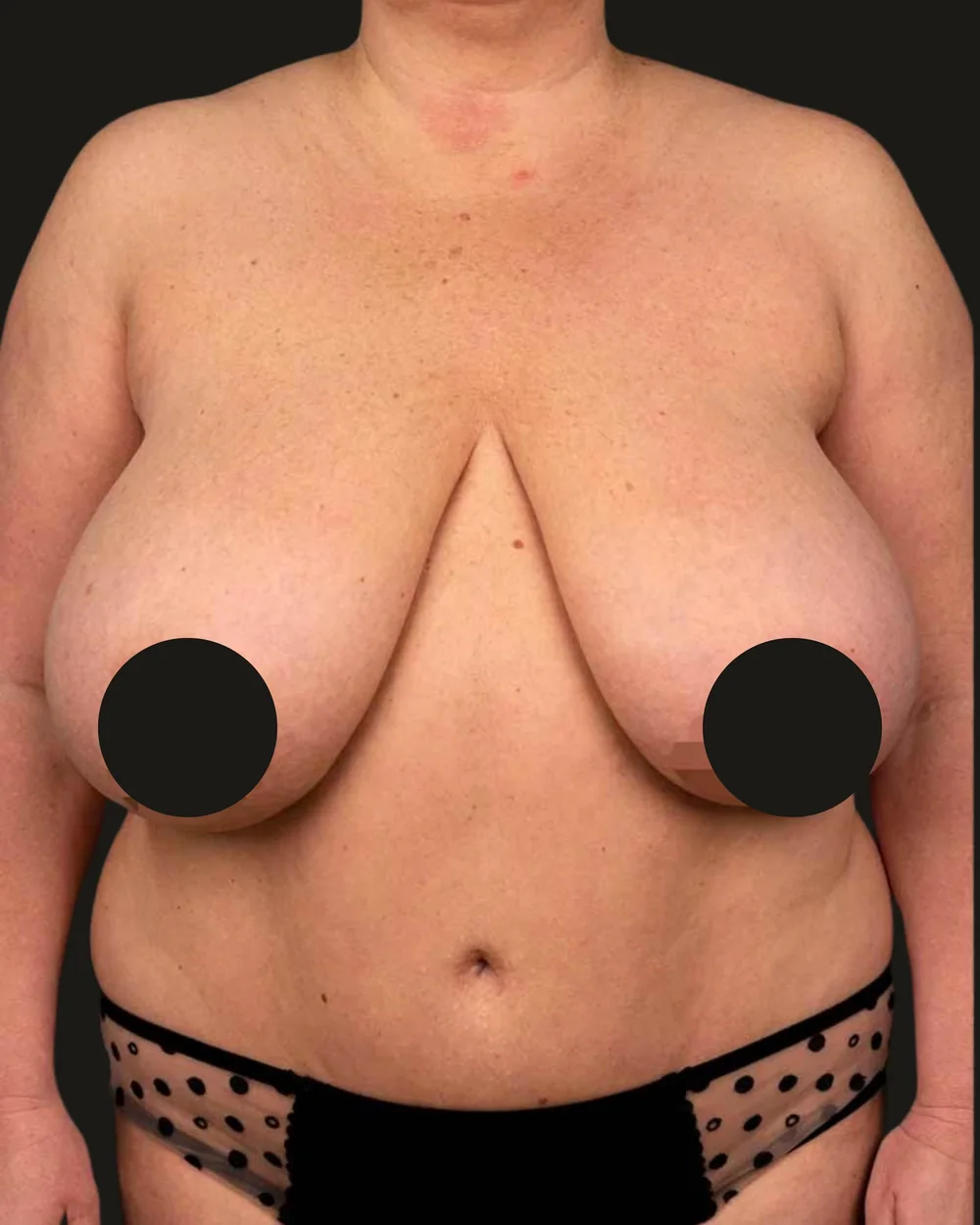 Breast reduction, before, anterior view