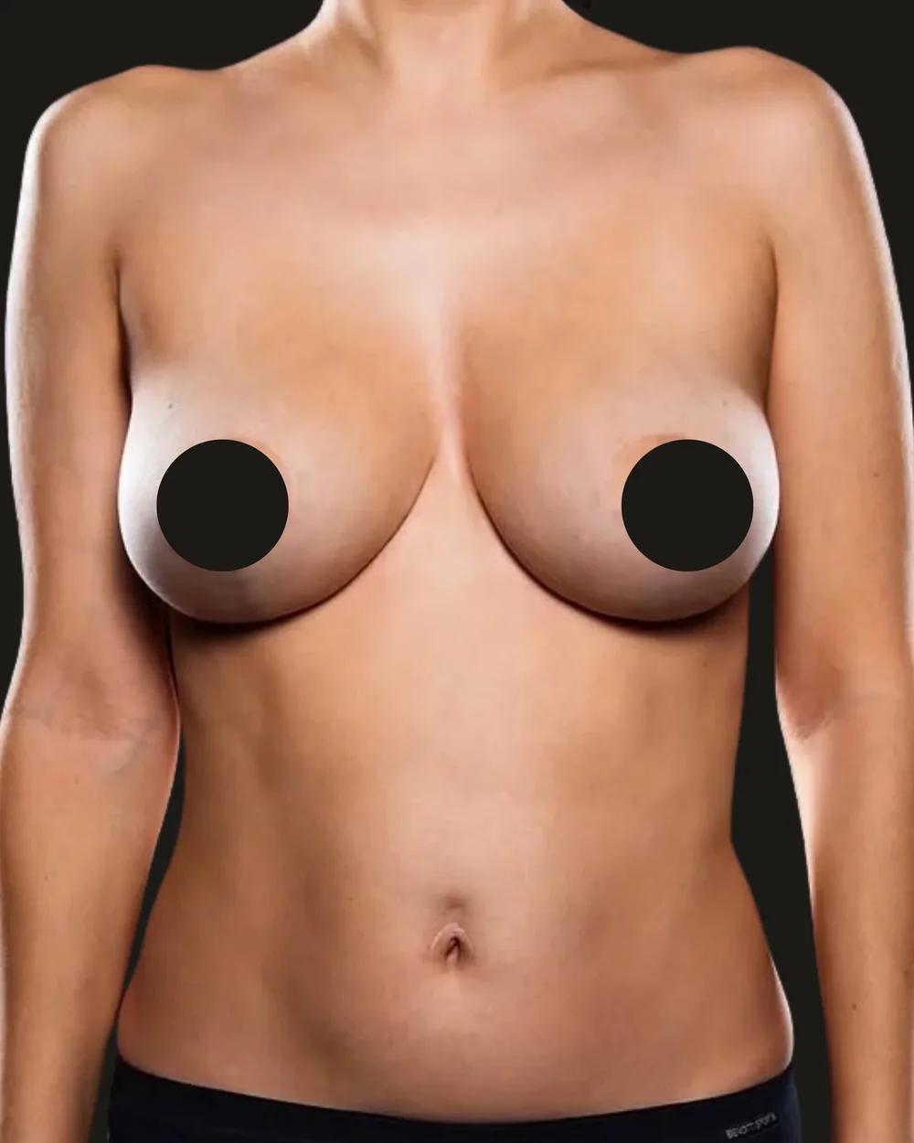 Breast reduction, after, anterior view