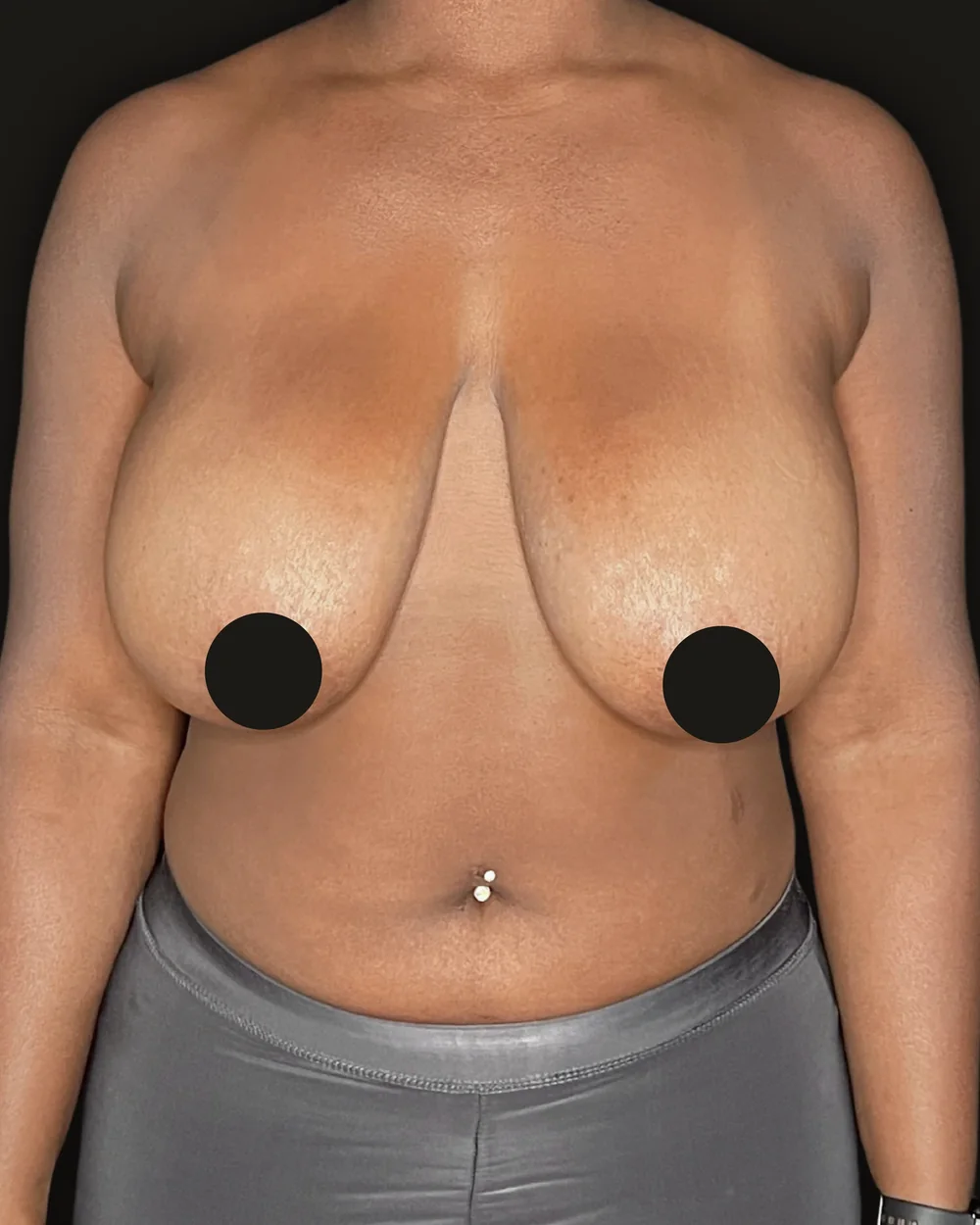Breast reduction, before, anterior view