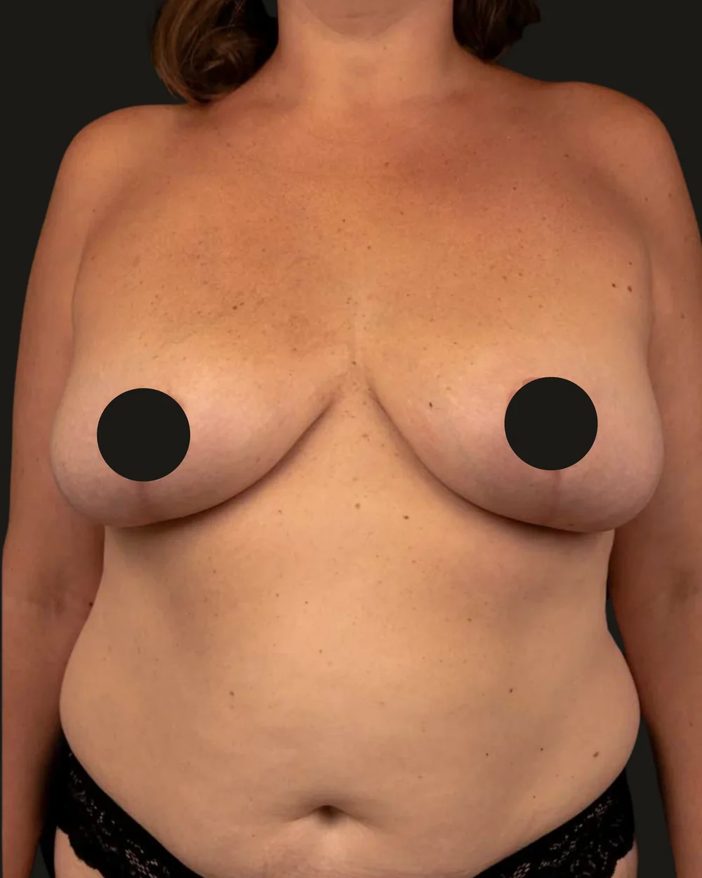 Breast reduction, after, anterior view