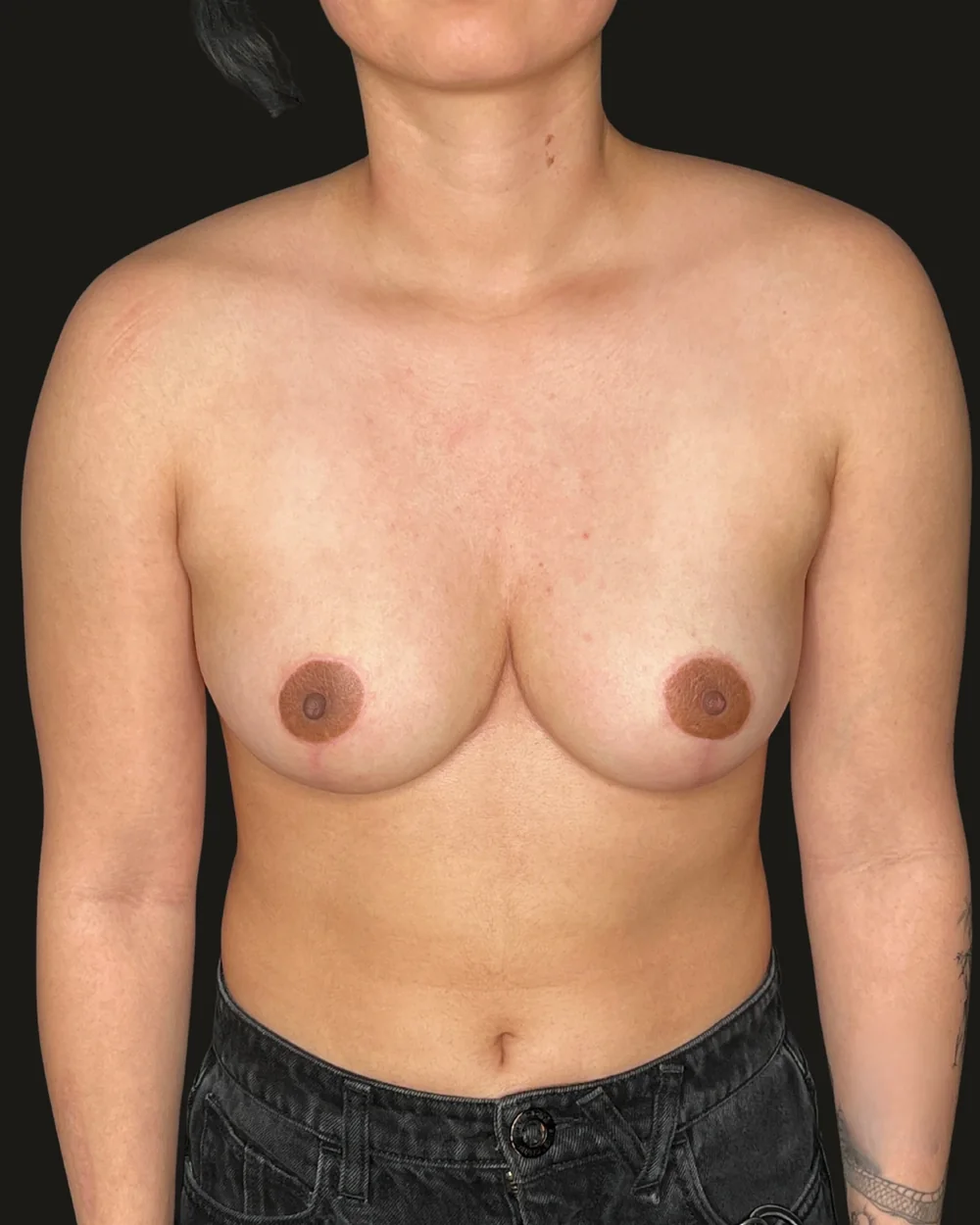 Breast reduction, after, anterior view