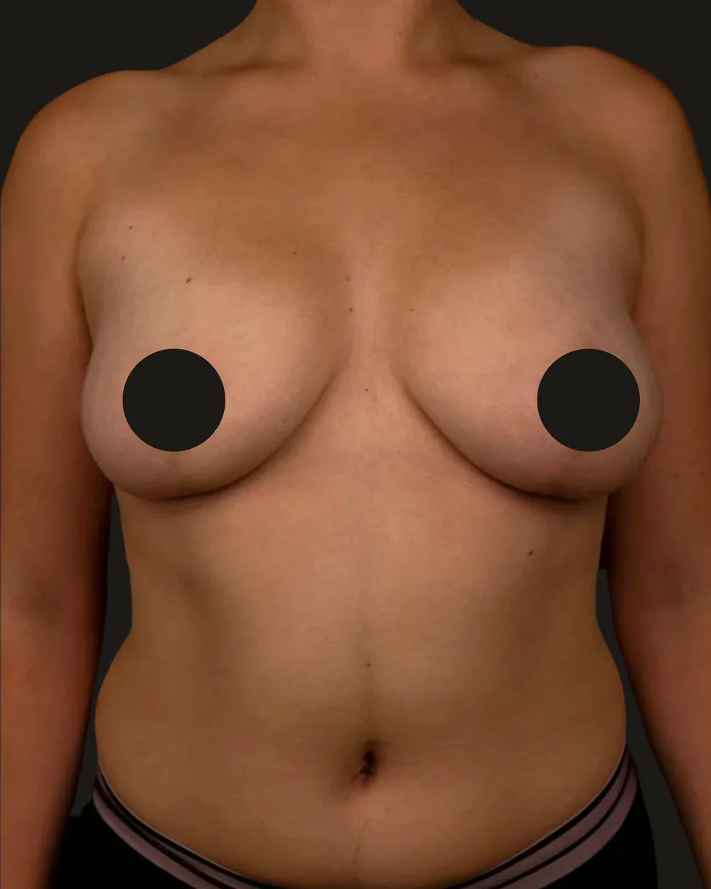Breast reduction, after, anterior view