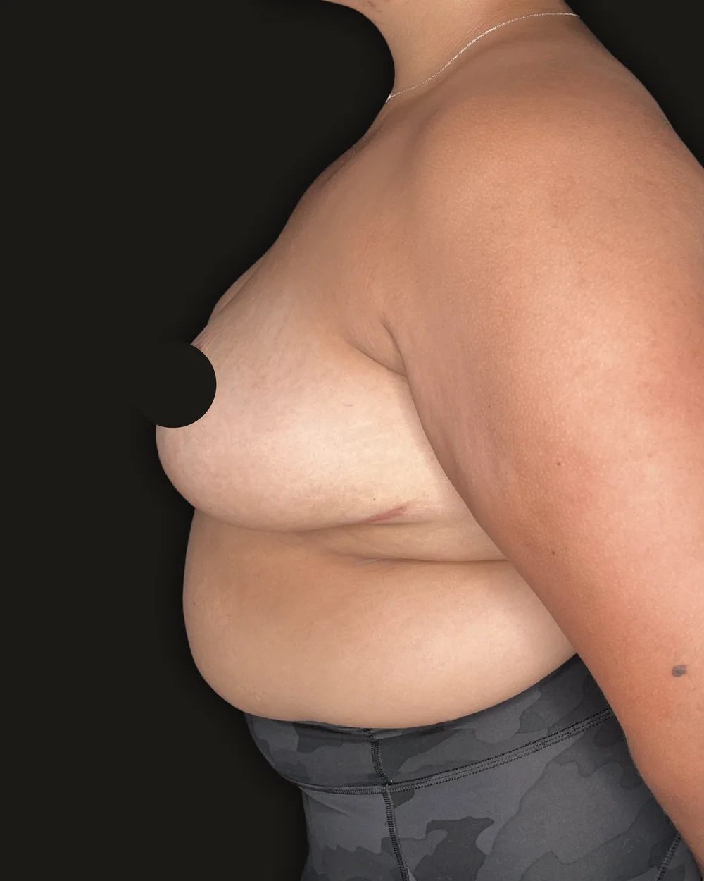 Breast reduction, after, anterior view