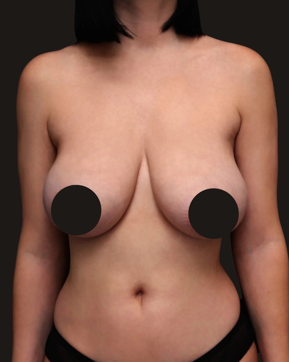 Breast reduction and lift, before, front view