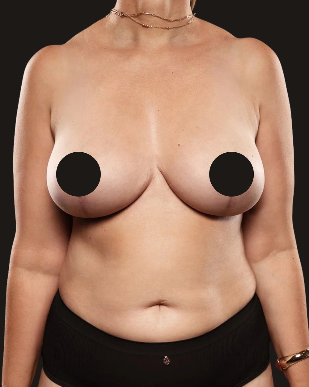 Breast reduction and lift, after, front view
