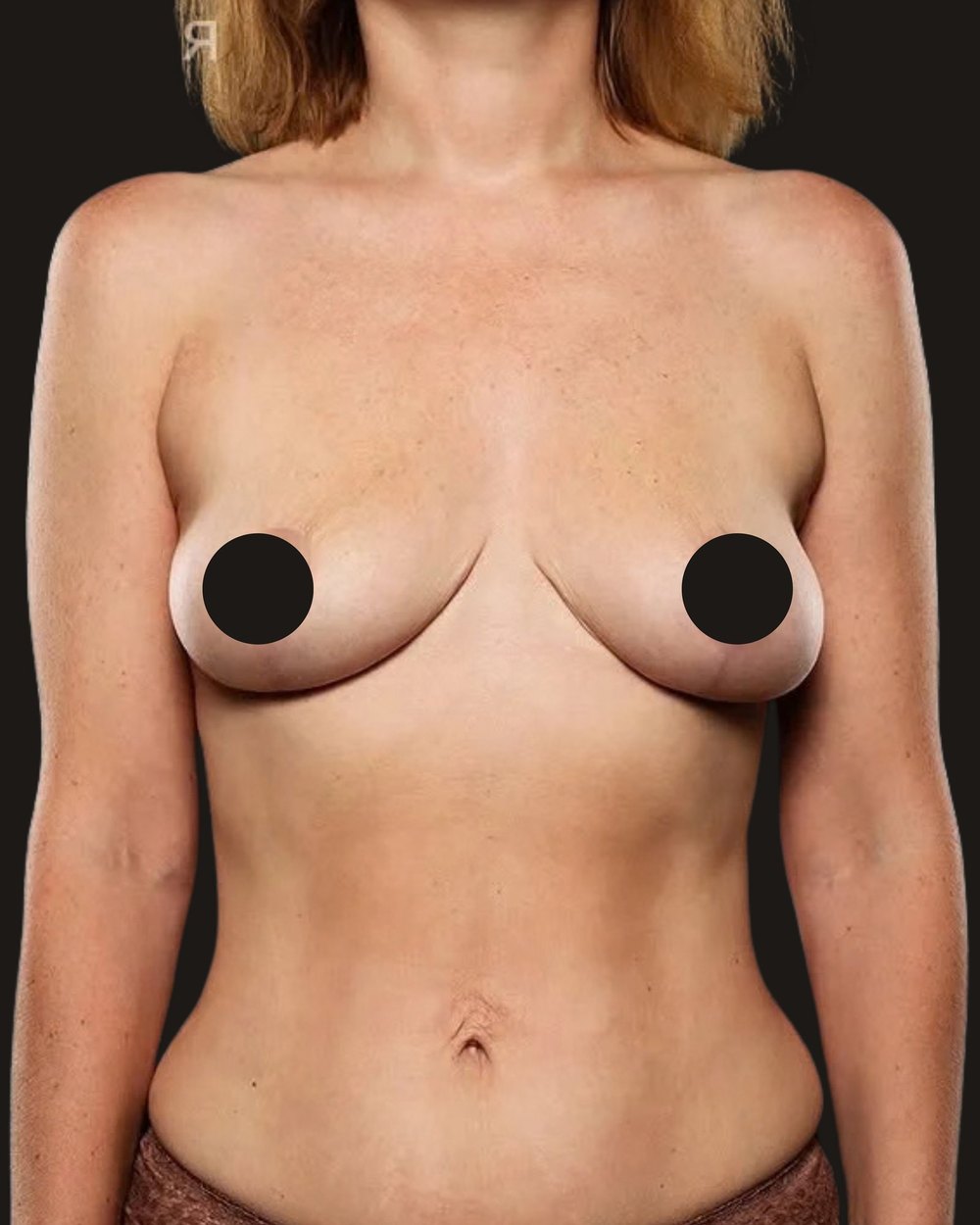 Breast reduction and lift, after, front view
