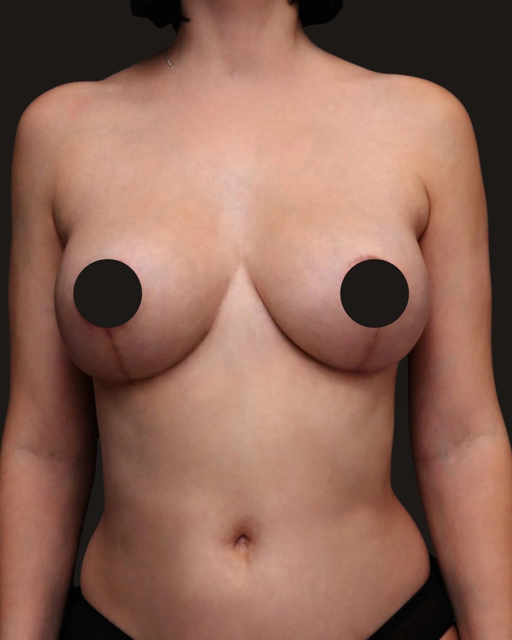 Breast reduction and lift, after, front view